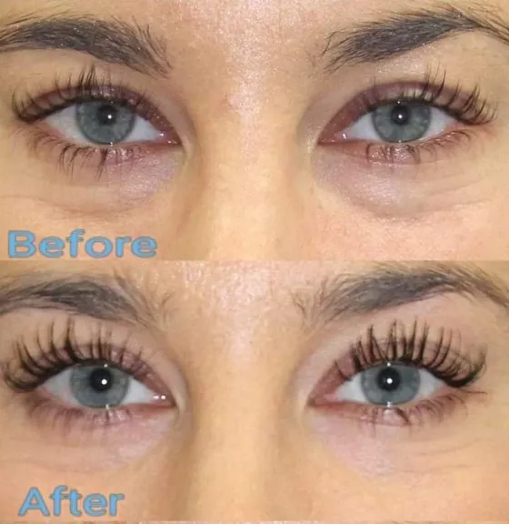 PRP injections under eyes